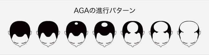 AGAの進行パターン