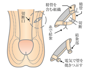 パイプカット（男性避妊手術）